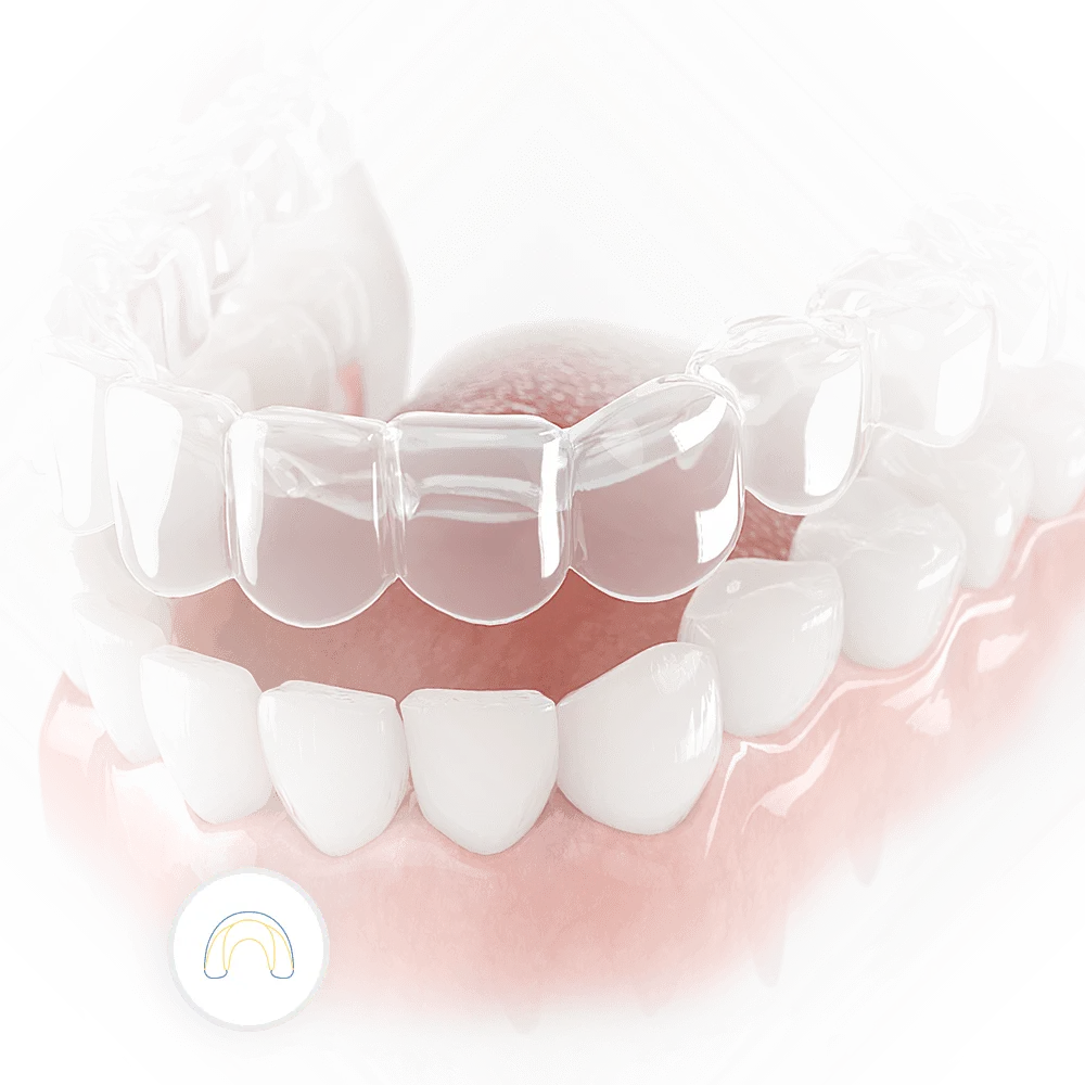 image of an Invisalign teeth straightening device for orthodontic treatment