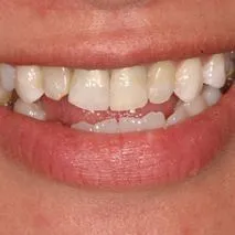 Before and after images showcasing dental treatment results. The 'Before' image displays slightly misaligned and discolored teeth with visible plaque. The 'After' image shows a transformation to perfectly aligned, bright white teeth, enhancing the smile with red lipstick. 