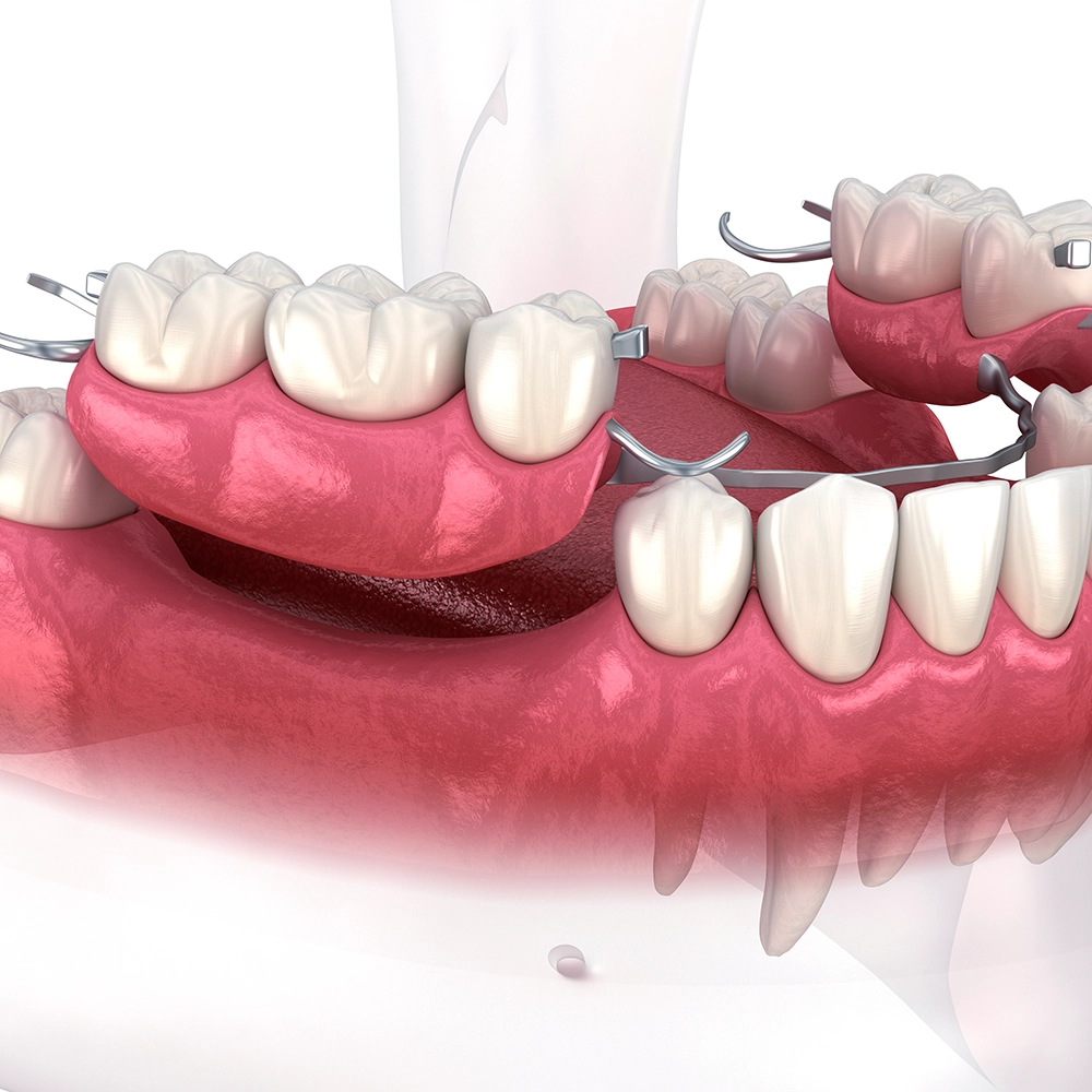 3D rendering of partial dentures against a pink background, focusing on the metal clasps and artificial teeth designed to fit alongside remaining natural teeth.