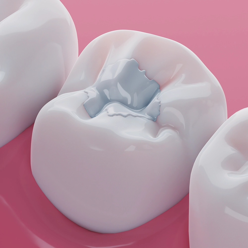 A 3D close-up of a molar with a silver dental filling in the cavity, representing a common pediatric dental procedure to treat tooth decay.