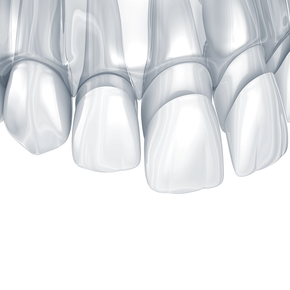  A 3D illustration showing transparent dental veneers being applied to the front teeth.