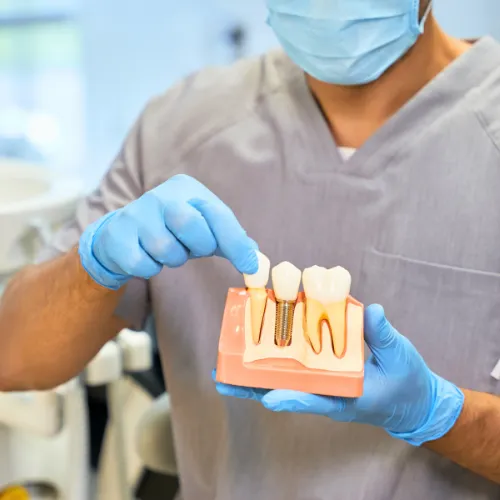 Man holding model of dental implant in gloved hands.
