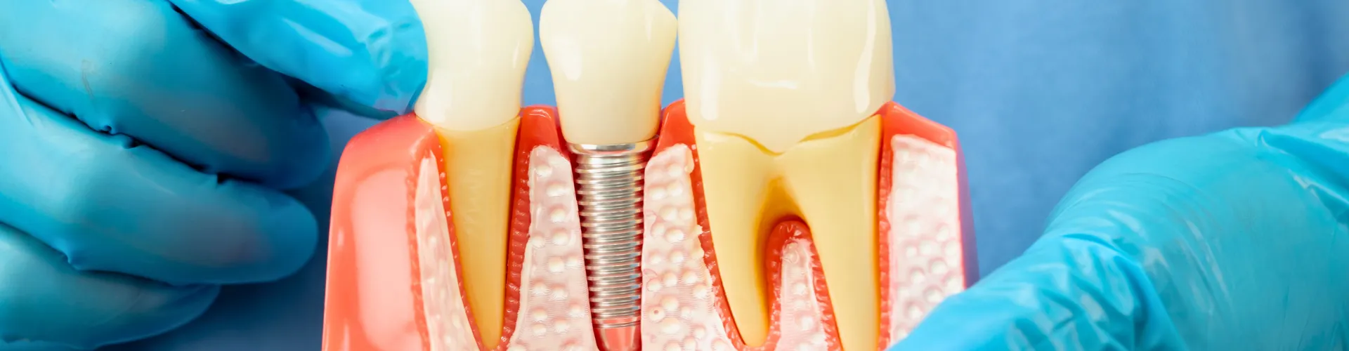 Gloved hands holding model of dental implant between teeth.