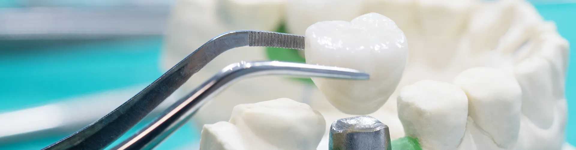 tweezers placing crown on implant in plaster jow model