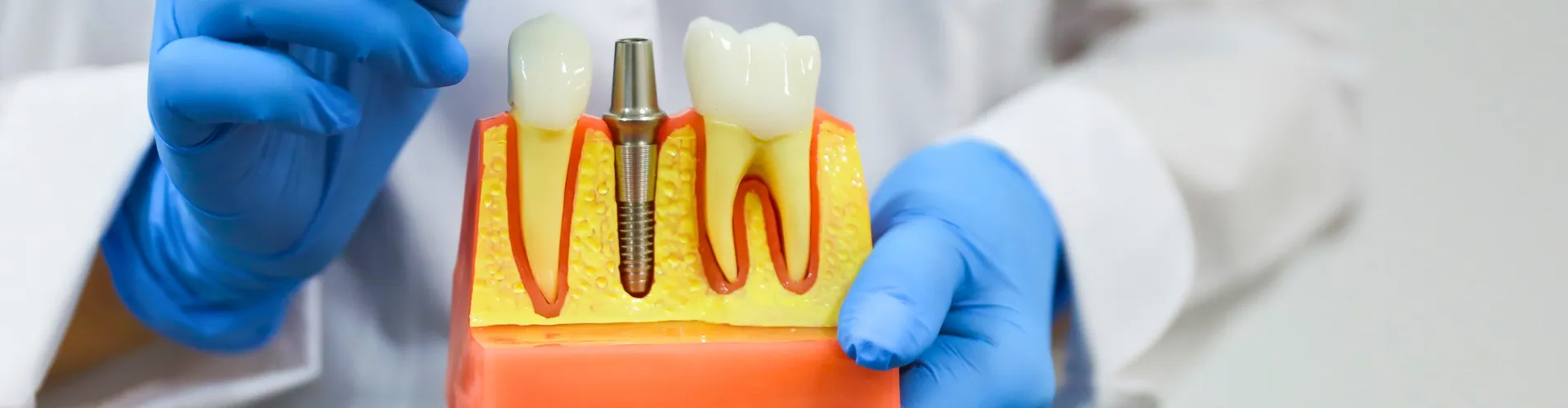 Model of an implant between two teeth.