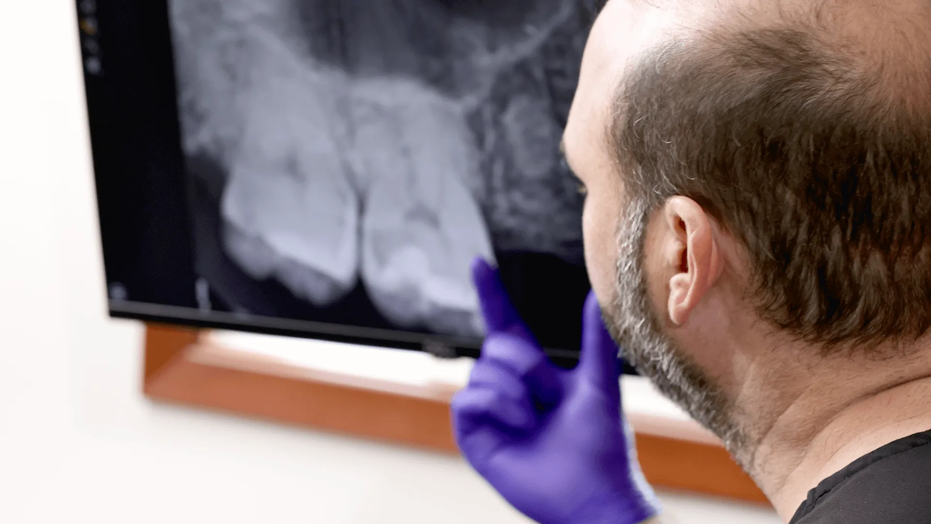 Dr. Vartanian, wearing gloves and pointing at a dental X-ray on a monitor, analyzing a patient’s tooth structure to plan a precise extraction procedure.