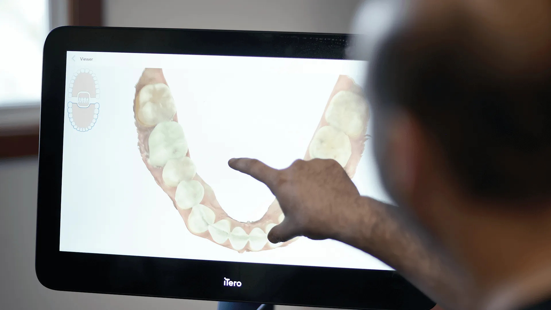  A close-up image of a dentist pointing at a digital scan of teeth displayed on a screen. The dentist is explaining the alignment and condition of the teeth, emphasizing the personalized care and attention to detail provided at Vartanian Dental Group.