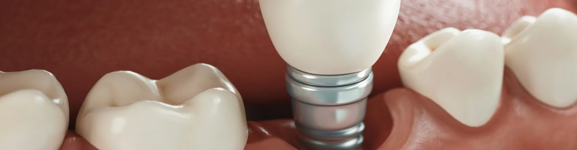 Rendering of an implant sitting in a lower jaw.