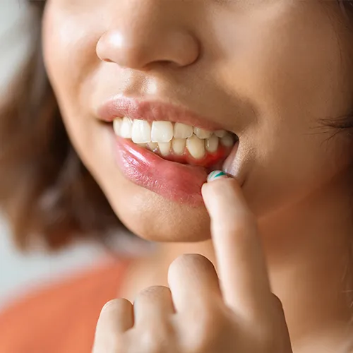 woman pulling down bottom lip to reveal inflamed gums