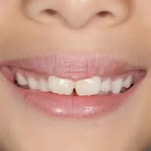 Before and after images displaying the results of dental treatment on a young patient's teeth. The 'Before' image shows teeth with noticeable plaque, slight yellowing, and misalignment. The 'After' image reveals a smile with brilliantly white, well-aligned teeth, enhancing the patient's youthful appearance.