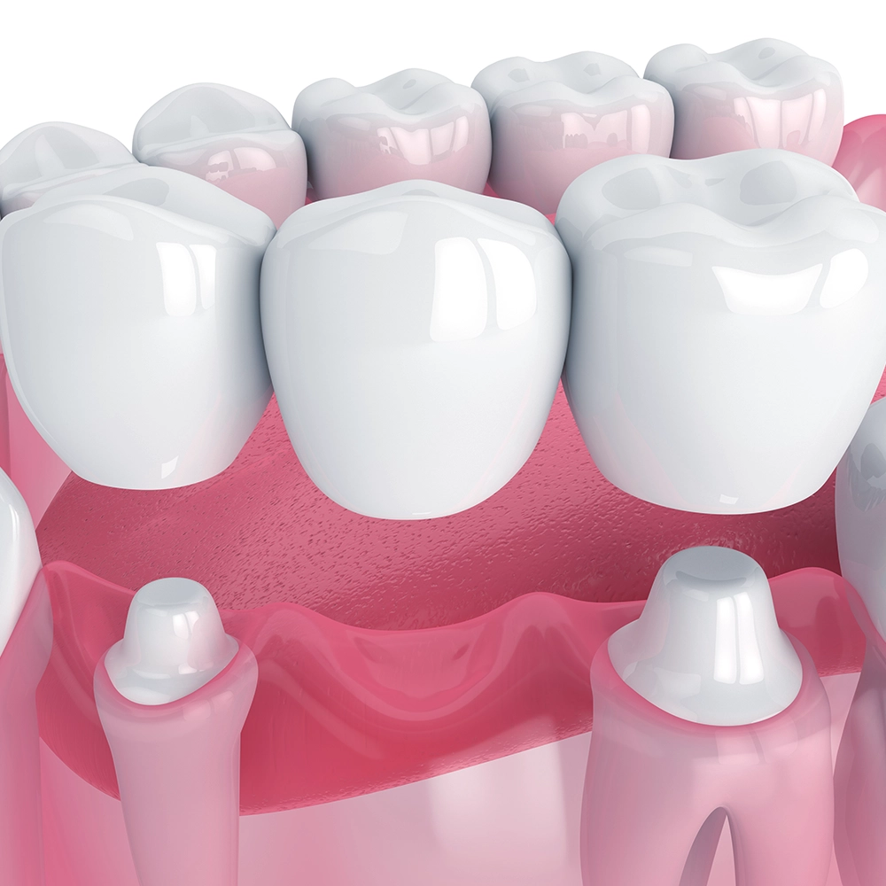 3D Close-up view of a dental bridge being fitted onto a patient's lower teeth.