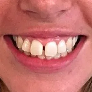 Before and after images displaying the results of dental treatment on a young patient's teeth. The 'Before' image shows teeth with noticeable plaque, slight yellowing, and misalignment. The 'After' image reveals a smile with brilliantly white, well-aligned teeth, enhancing the patient's youthful appearance.