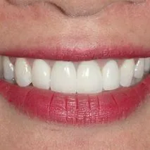 Before and after images showcasing dental treatment results. The 'Before' image displays slightly misaligned and discolored teeth with visible plaque. The 'After' image shows a transformation to perfectly aligned, bright white teeth, enhancing the smile with red lipstick. 