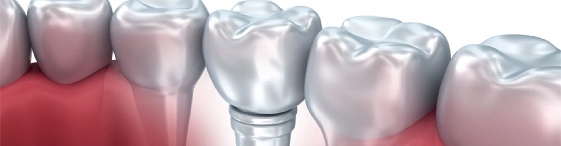 Dental implant illustration