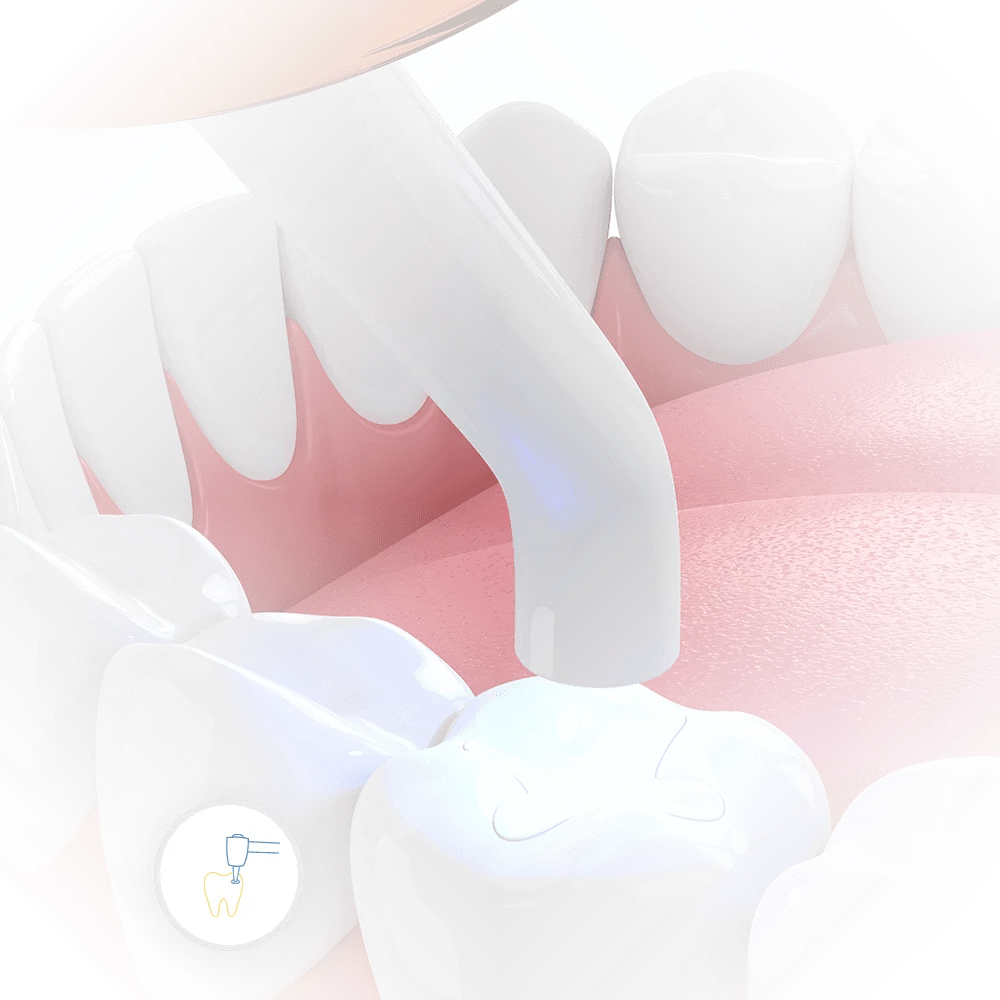 image of light curing device working to harden composite materials for dental cavity filling 