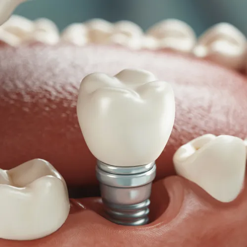 Rendering of an implant sitting in a lower jaw.