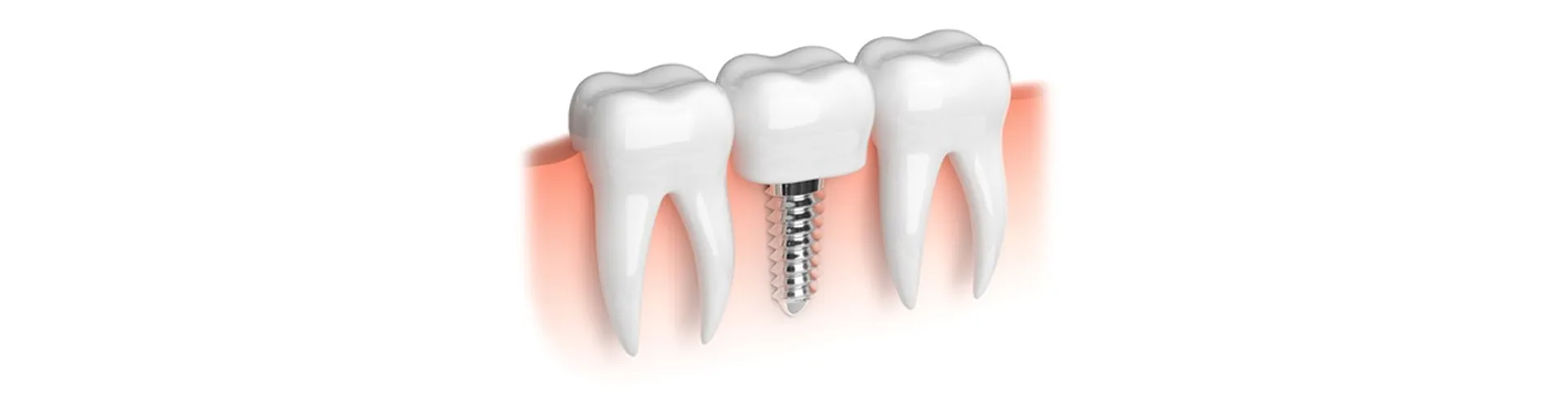 Dental implant illustration