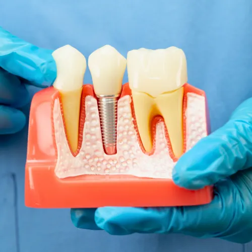 Gloved hands holding model of dental implant between teeth.