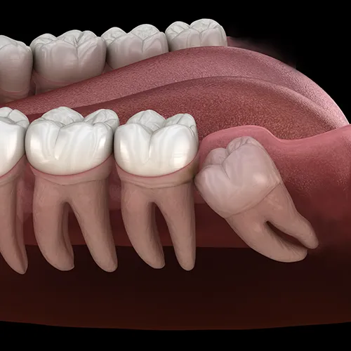 Rendering of a manidble with impacted wisdom tooth.
