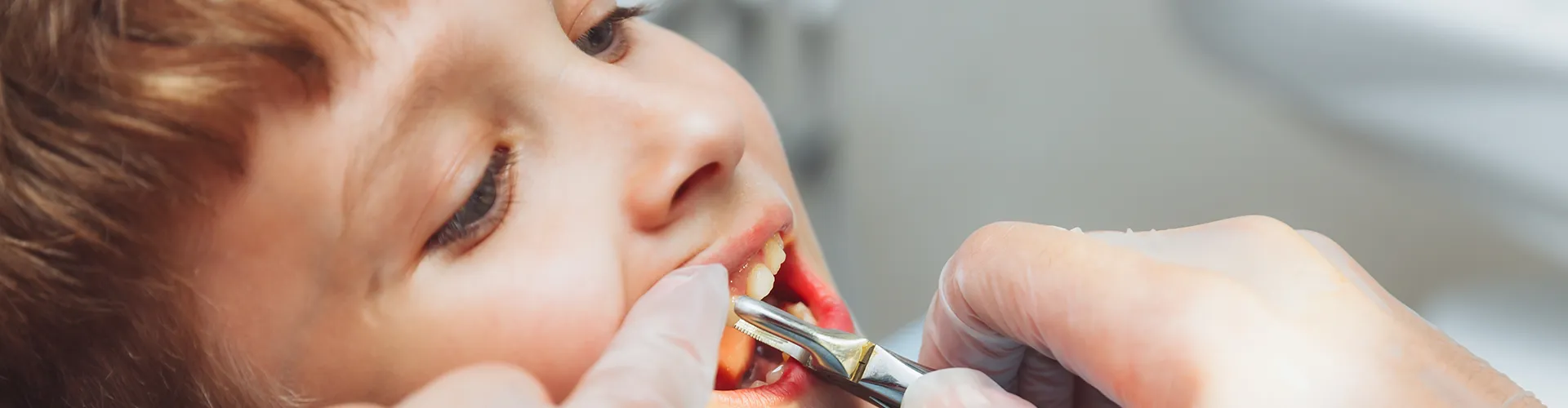 gloved hands using dental tool to pull child's tooth