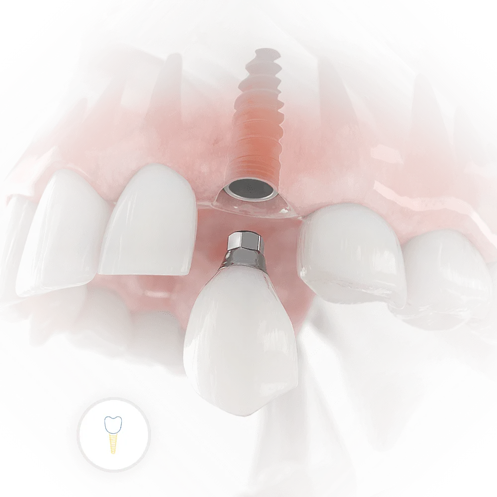 3D image rendering of dental implant being assembled directly in to the upper jaw bone