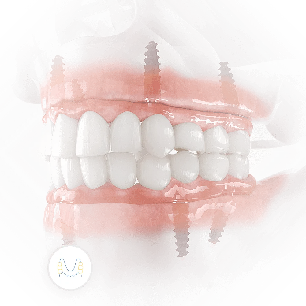 3D rendering of upper and lower implant retained dentures, snap in dentures